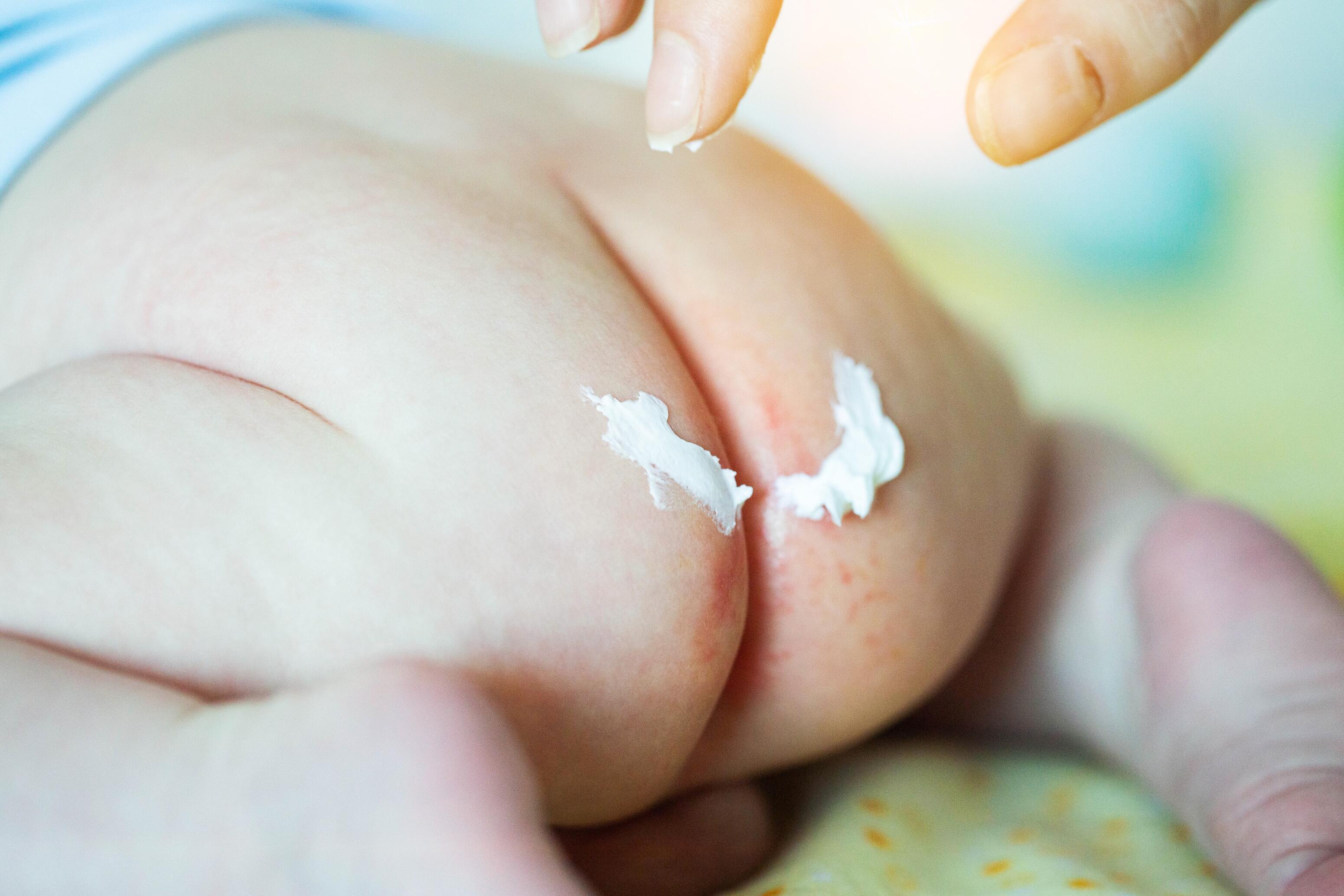 Dermatitis del pañal en los bebés